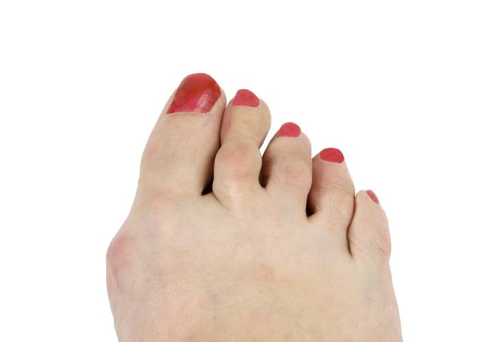 What Causes Hammertoes and How Are They Treated?