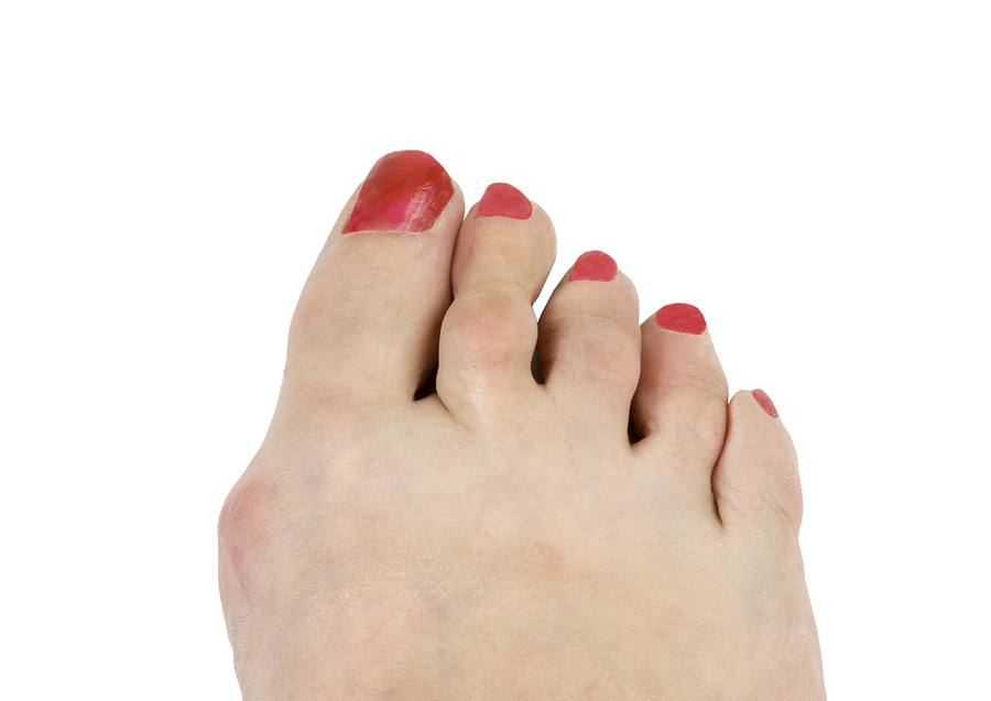 Hammertoe, what is it and how do you treat it – My-Happy Feet